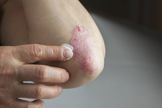 Applying emollient to psoriasis