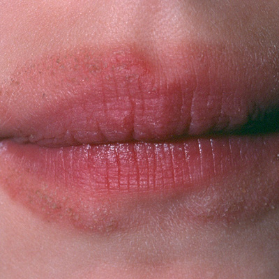 Clinical Quiz: perioral eczema | Chemist+Druggist