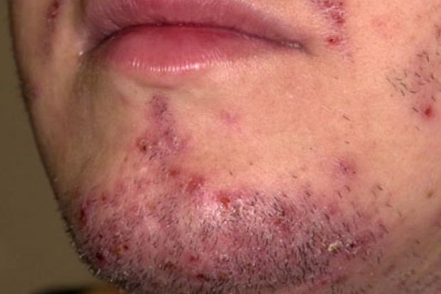 Shaving chin rash
