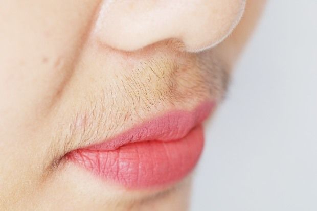 Hirsutism causes excessive hair growth in androgen-dependent areas Hirsutism causes excessive hair growth in androgen-dependent areas