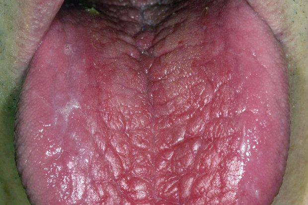 Scrotal tongue Scrotal tongue