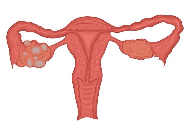 A polycystic ovary is slightly larger than a normal ovary and contains twice the number of follicles A polycystic ovary is slightly larger than a normal ovary and contains twice the number of follicles