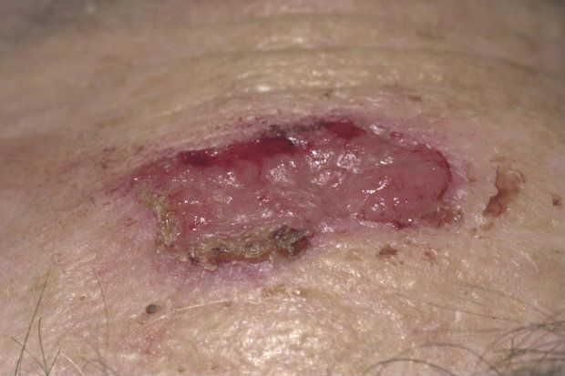 Image of a sore that turned out to be an amelanotic melanoma