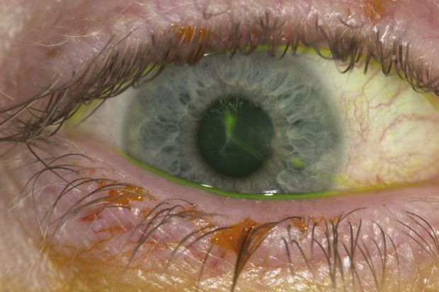 CORNEAL ABRASION
