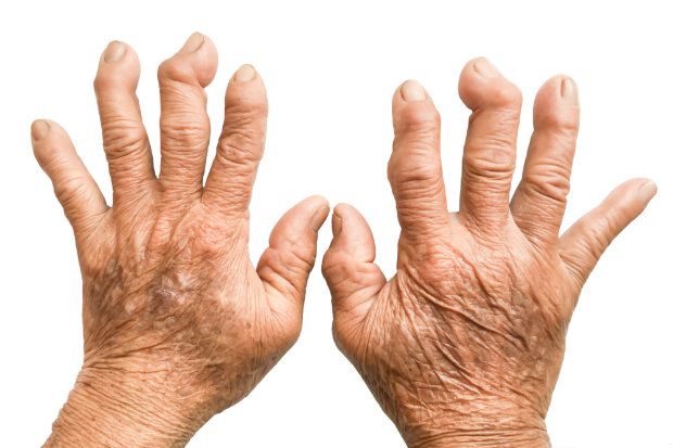Image result for (Rheumatoid Arthritis)