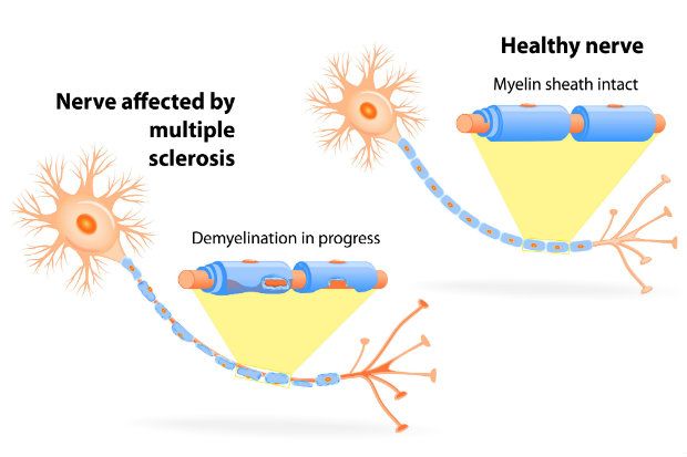 Multiple sclerosis nerve demylination