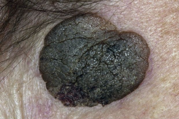 Would you refer a patient with this lesion on their face? | Chemist ...