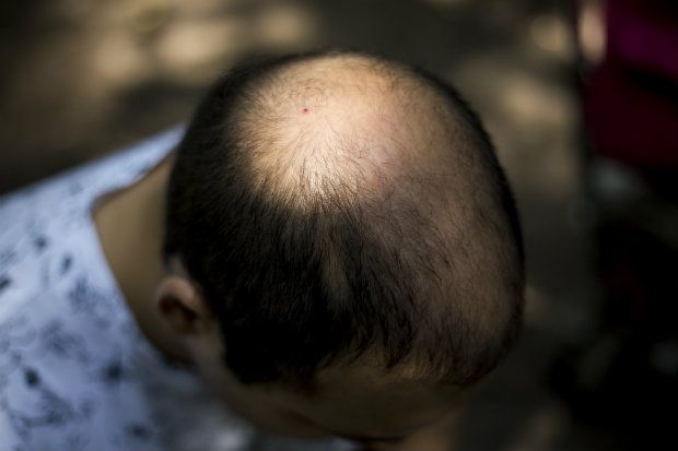 different types of hair loss