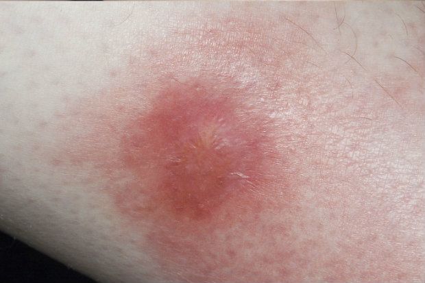 Erythema nodosum: What are these red bumps on the shins? | Chemist+Druggist