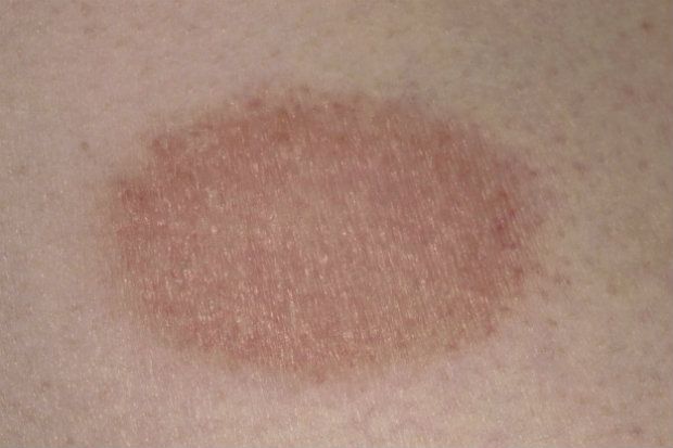 Would you recognise a fixed drug eruption? Would you recognise a fixed drug eruption?
